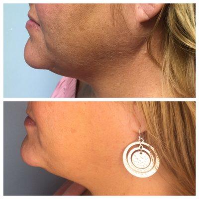 Kybella -the "Fat Dissolver" after 2 treatments. 3-6 Treatments are recommended for full results.