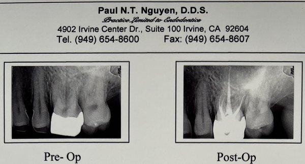 Pre-op and post-op images of root canal on tooth #14