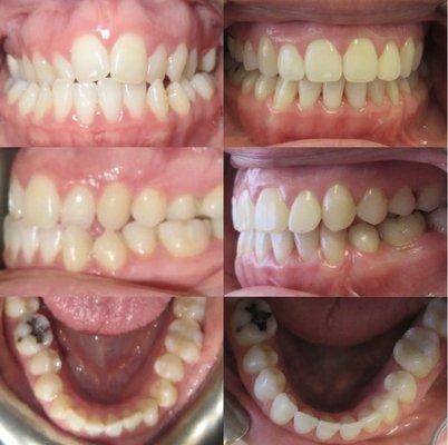 Underbite and crossbites treated without surgery, only one tooth removed and great rubberband compliance