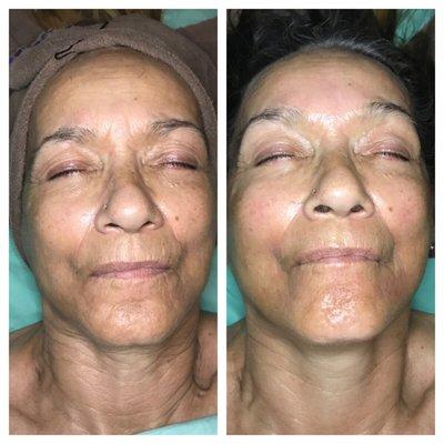 This is a before and after of a microdermabrasion, wrinkle Lift Peel, and facelift treatment!