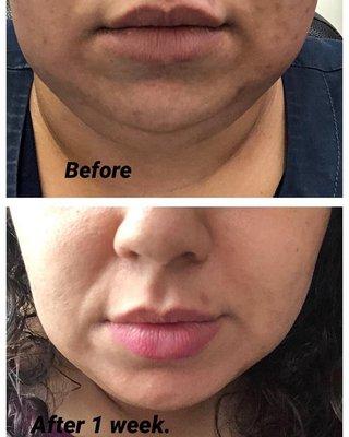 Mesotherapy results