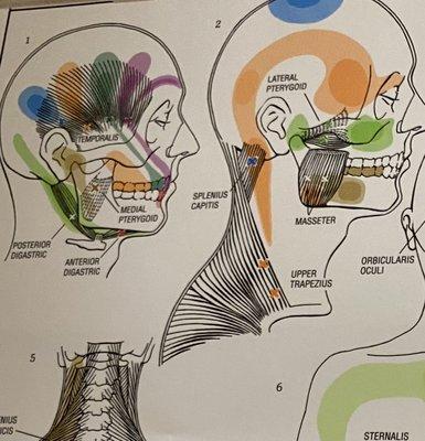 Trigger points for TMJ etc.