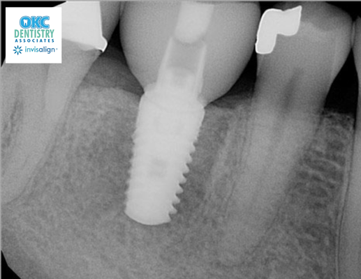 Dental Implant with Custom Crown to replace a missing tooth.