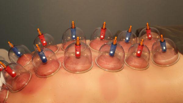 Cupping is a beneficial addition to a massage session to help reduce pain!