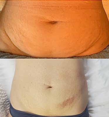 Ultrasonic Lipo