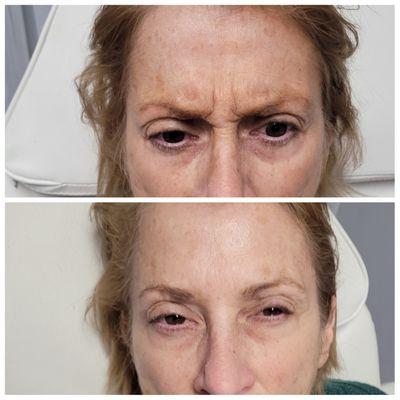 Before and after anti-wrinkle injections with botox!