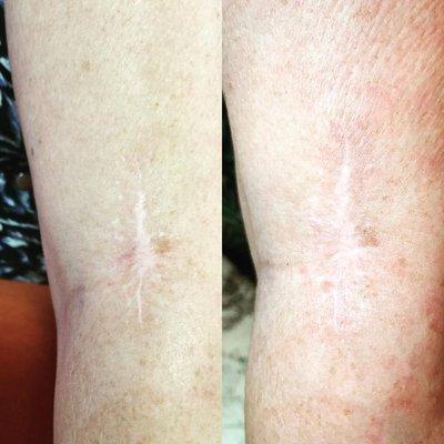 Non invasive scar treatment. The right pic was taken after 3 months.