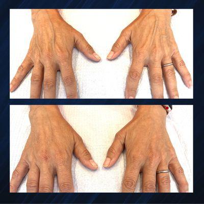 Hand Rejuvenation