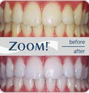 Zoom Whitening