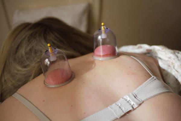 Cupping