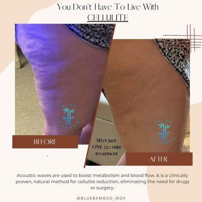 Banish cellulite in 20 mins! One acoustic wave session gave this outer thigh a smoother texture. Immediate results, visibly stunning!