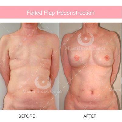 Before and after failed flap reconstruction on a 53 year old woman who had a bilateral mastectomy.