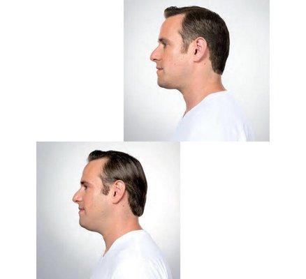 Kybella injection before & after on male