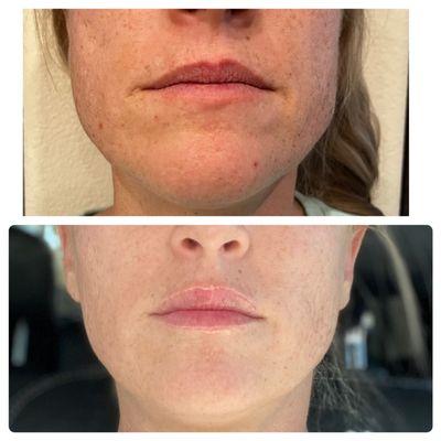 Microneedling with PRP, Botox lip flip, and Botox jaw contouring