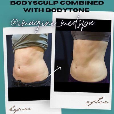 Bodysculp & Bodytone Combination Treatment

Targets and destroys treated fat cells

While muscle sculpting & toning