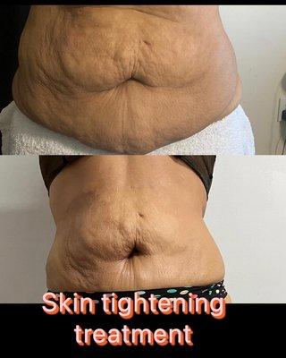 Abdomen skin tightening treatment