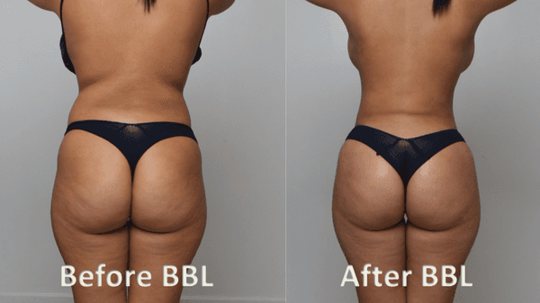 Model Makeover 360 Lipo BBL