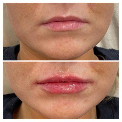 Service: Luscious Lips with Filler