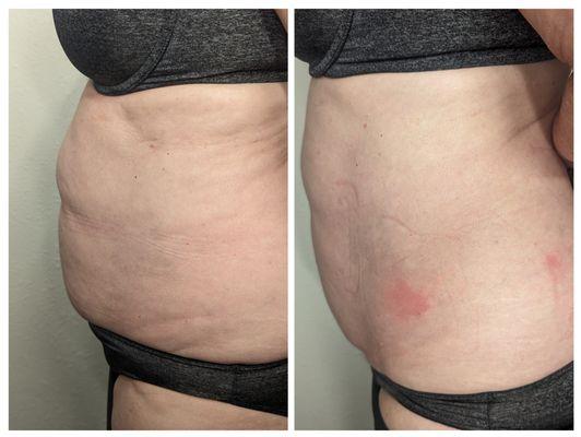 Stomach fat reduction before and after 1 treatment