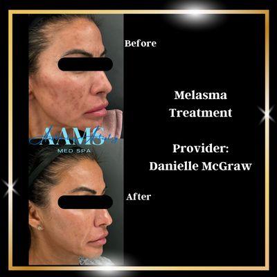 Melasma & acne scar treatment