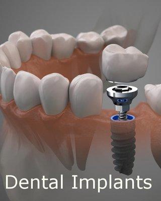 Cutaway of a Mouth Showing Natural Fit Dental Implants