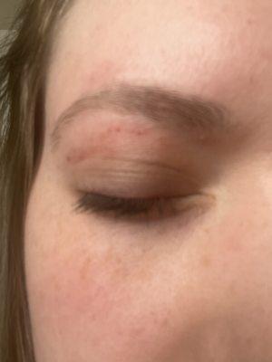 Redness and scabs after my eyebrow wax.