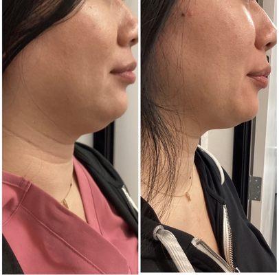 Before and after one Kybella treatment