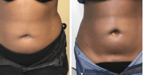 Cryotherapy is a non-invasive way to slim your abdomen by freezing the fat cells