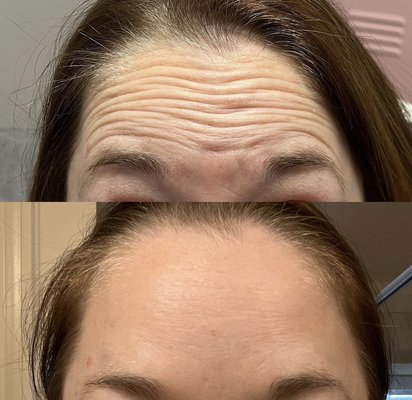 Botox Before & After