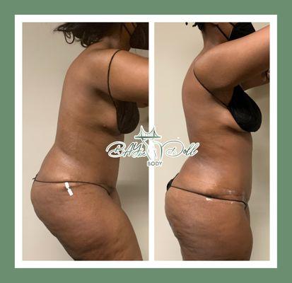 Tummy tuck