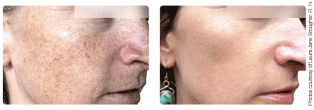 BBL, phototherapy for freckles, age spots, and fine lines