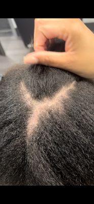 Bald spots and hair loss due to a terrible quickweave installation