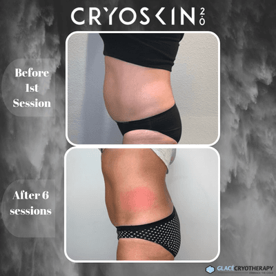 CryoSlimming results~