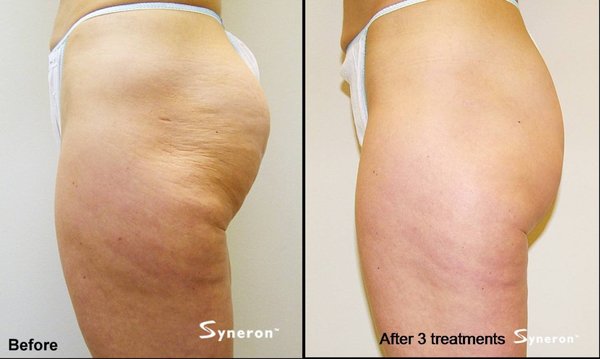 before and after VelaShape fat reduction