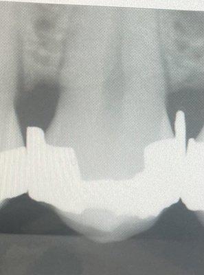 Bad filling into my gums