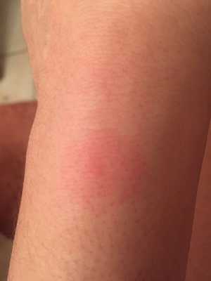 The next day after putting cortisone on my weird bite from Douglas Motel. It looks much better here than it did yesterday. Beware