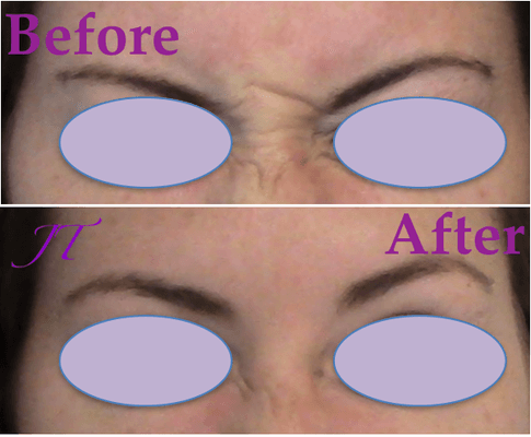 Before and After Botox Injections in Glabella.