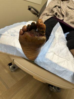 Dry gangrene and dead flesh