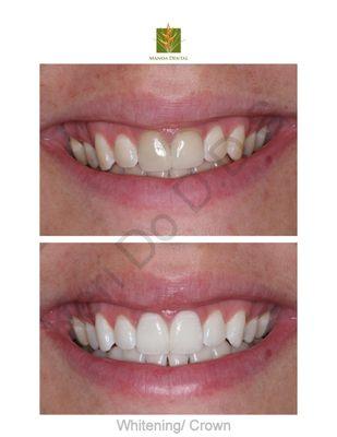 Power whitening, 2 Porcelain Veneers and Dental Implants