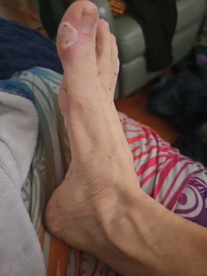 My foot after having to dig for tens of hours straight.