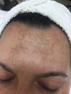 Hyper pigmentation before treatment