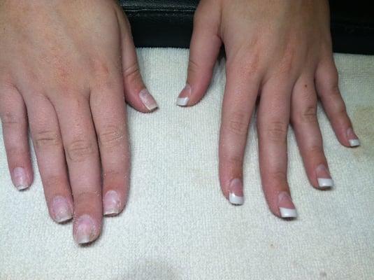 Before pic. Had to remove thick, layered acrylic completely down to the natural nail. Found glitter and fungus underneath.