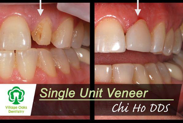 Single-unit Veneer case. Single units are more difficult to match shade. But you can trust us picking the correct tooth color to match.