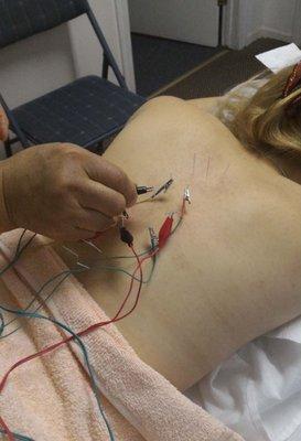 Electro-stimulation with Acupuncture