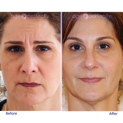 Botox to smooth frown lines and crows feet, 2 cc of Voluma to plump the cheeks and 1 cc of Juvederm for smile lines correction