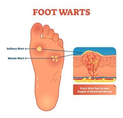 Plantar Warts