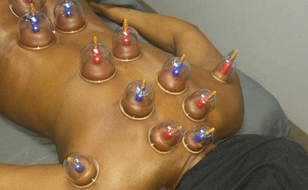 Cupping Therapy