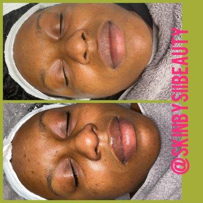 Before & After skin transformation of a facial