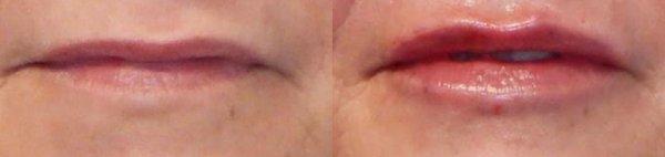 Before and immediately after filler was applied to the lips