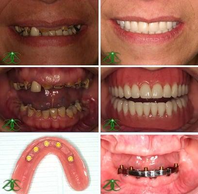 Sample before/after photo (actual patient)